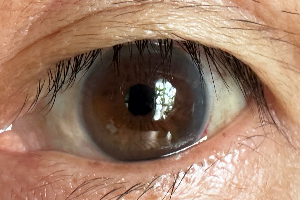 術後10日の左眼